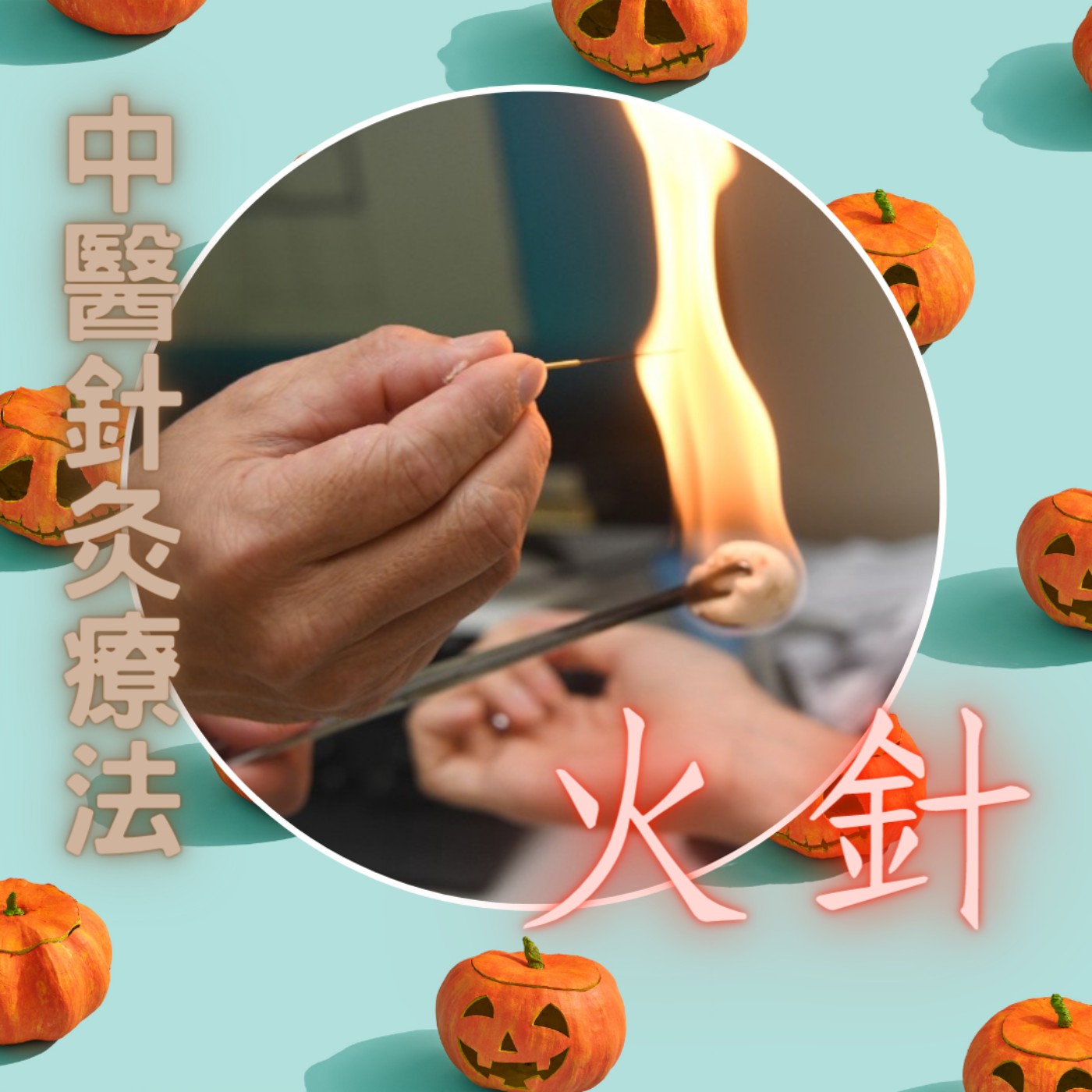 中醫針灸療法~火針 中醫針灸療法~火針