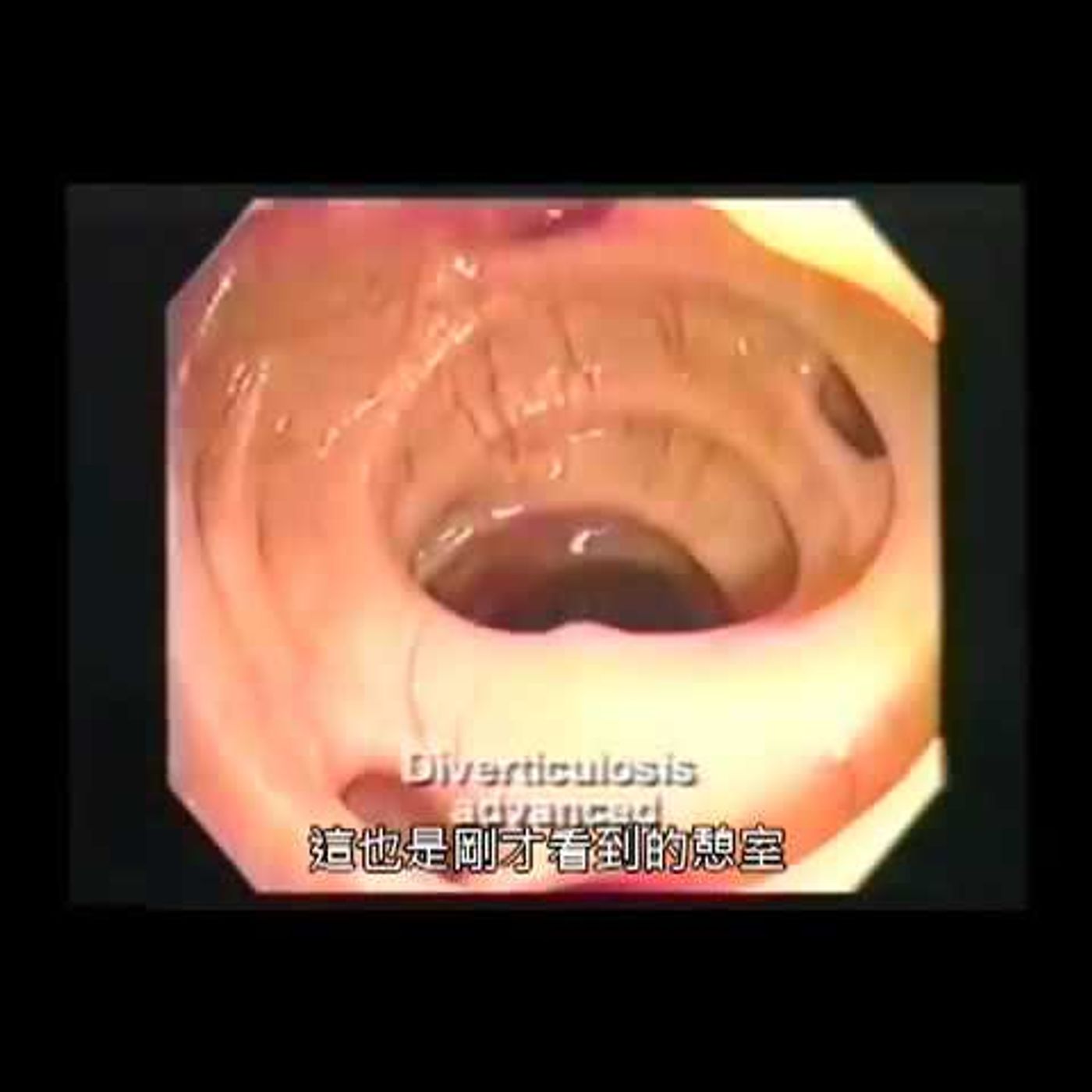 大腸內視鏡下的「肉食與純素者的腸相」--新谷弘實博士 episode artwork